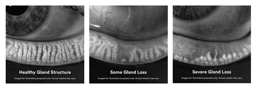 Visual representation of healthy eye glands